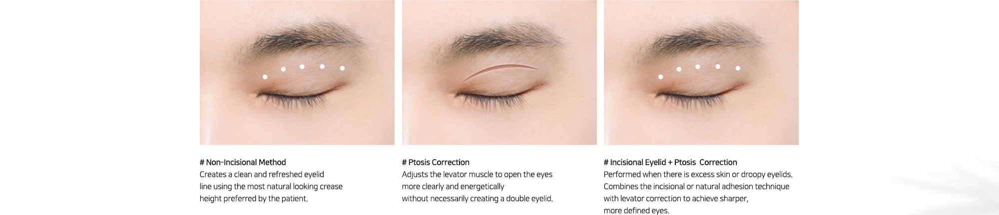 # Non-Incisional Method : Creates a clean and refreshed eyelid line using the most natural looking crease height preferred by the patient.   # Ptosis Correction : Adjusts the levator muscle to open the eyes more clearly and energetically without necessarily creating a double eyelid.   # Incisional Eyelid + Ptosis  Correction : Performed when there is excess skin or droopy eyelids. Combines the incisional or natural adhesion technique with levator correction to achieve sharper, more defined eyes.