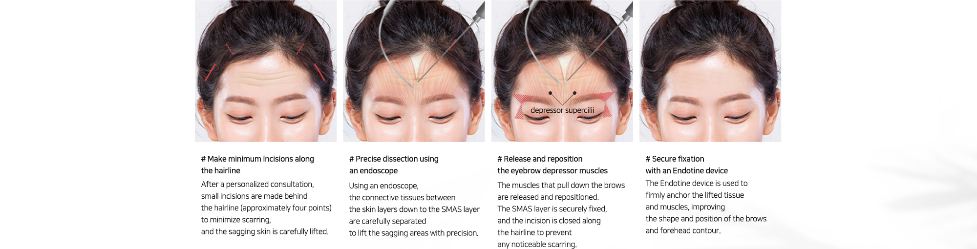 # Make minimum incisions along the hairline   # Precise dissection using an endoscope   # Release and reposition the eyebrow depressor muscles   # Secure fixation with an Endotine device