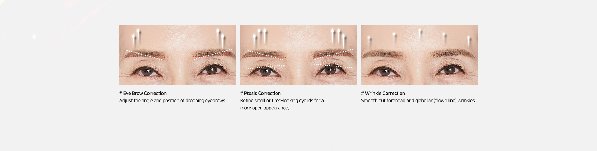# Eye Brow Correction : Adjust the angle and position of drooping eyebrows.   # Ptosis Correction : Refine small or tired-looking eyelids for a more open appearance.   # Wrinkle Correction : Smooth out forehead and glabellar (frown line) wrinkles.