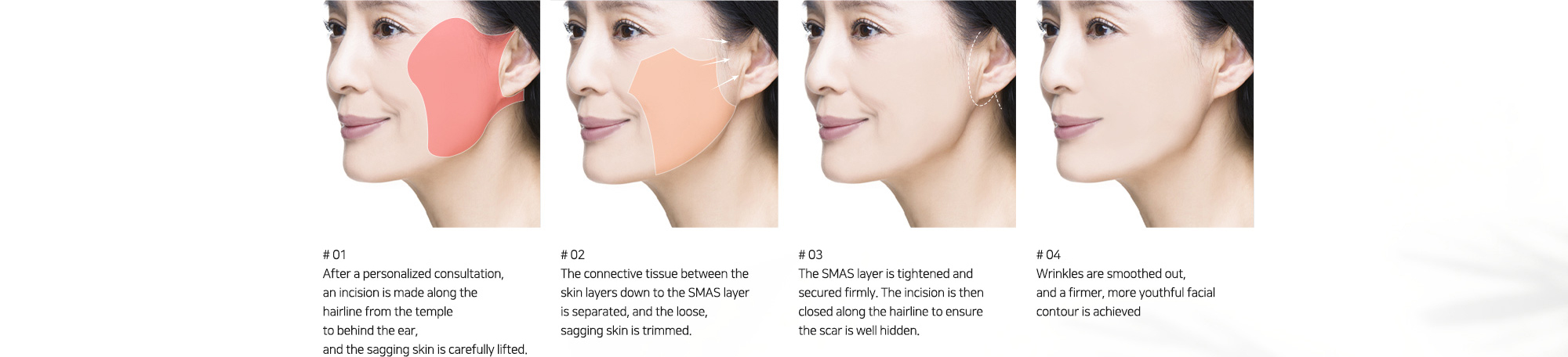 # 01 : After a personalized consultation, an incision is made along the hairline from the temple to behind the ear, and the sagging skin is carefully lifted.   # 02 : The connective tissue between the skin layers down to the SMAS layer is separated, and the loose, sagging skin is trimmed.   # 03 : The SMAS layer is tightened and secured firmly. The incision is then closed along the hairline to ensure the scar is well hidden.   # 04 : Wrinkles are smoothed out, and a firmer, more youthful facial contour is achieved