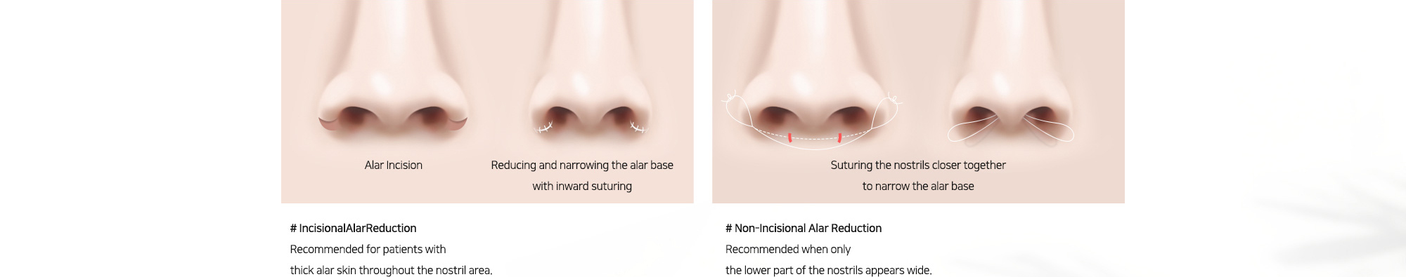 # IncisionalAlarReduction : Recommended for patients with thick alar skin throughout the nostril area.   # Non-Incisional Alar Reduction : Recommended when only the lower part of the nostrils appears wide.