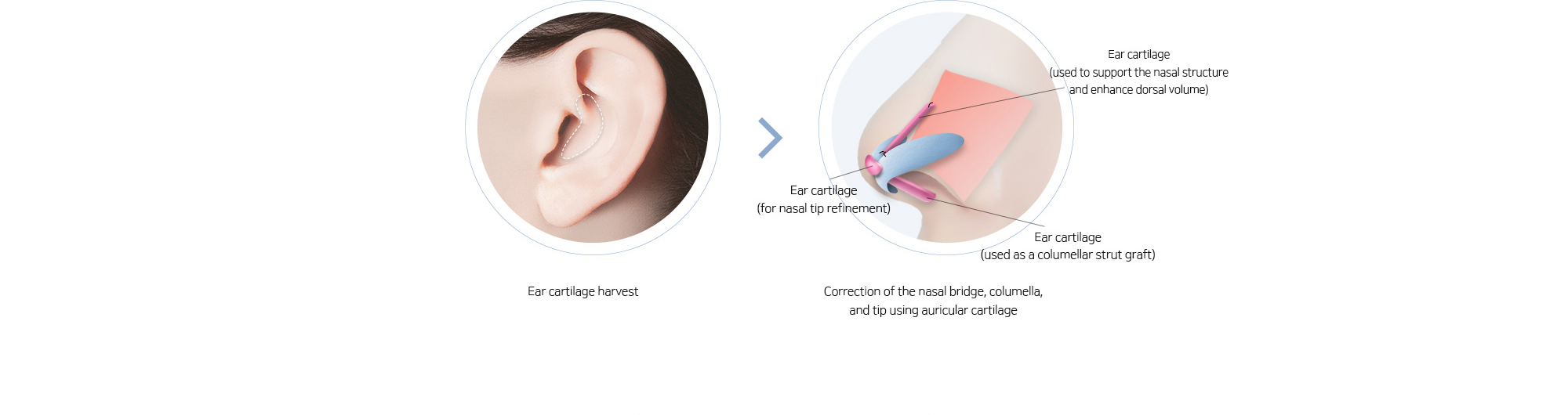 Ear cartilage harvest > Correction of the nasal bridge, columella, and tip using auricular cartilage