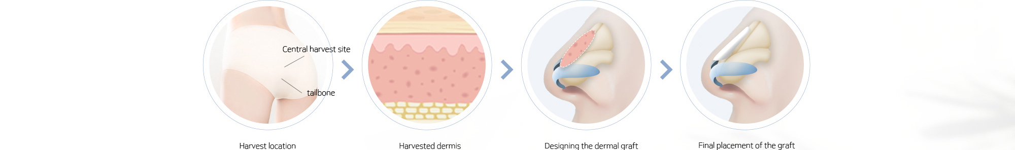 Harvest location > Harvested dermis > Designing the dermal graft > Final placement of the graft