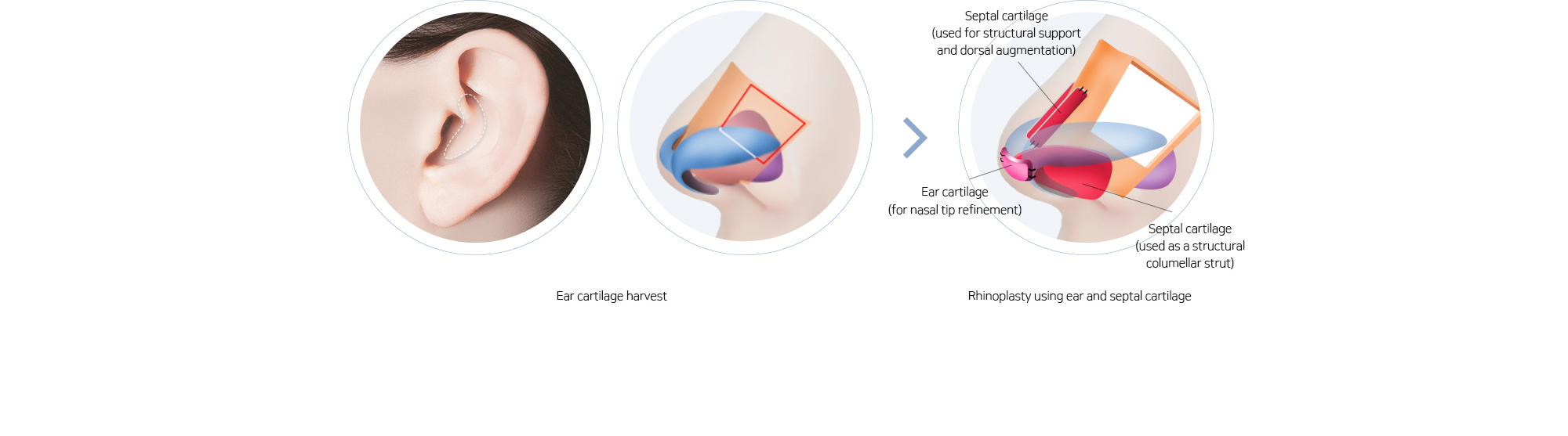 Ear cartilage harvest > Rhinoplasty using ear and septal cartilage