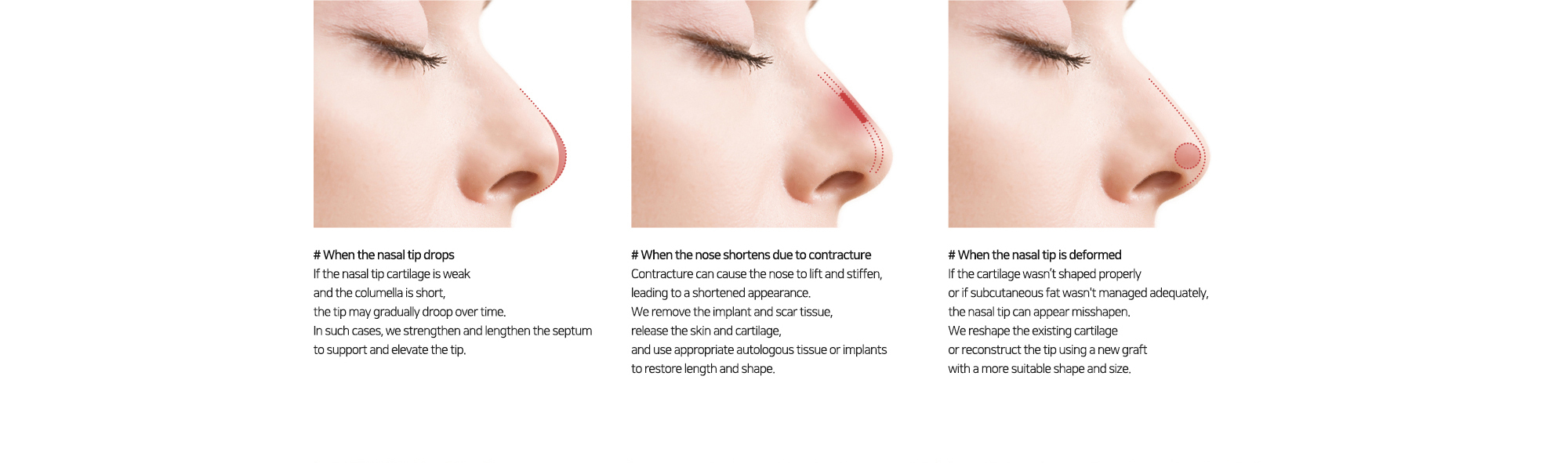 # When the nasal tip drops   # When the nose shortens due to contracture   # When the nasal tip is deformed