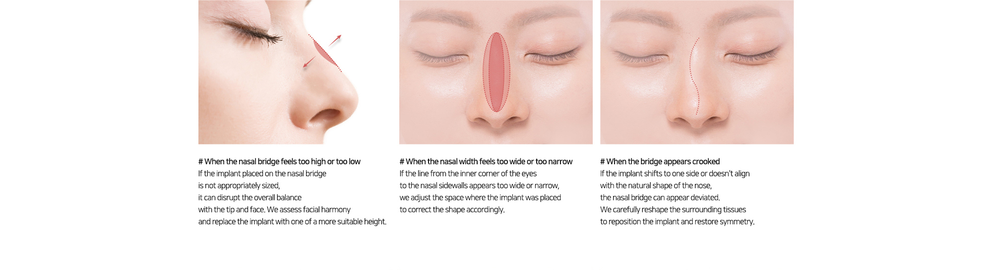 # When the nasal bridge feels too high or too low   # When the nasal width feels too wide or too narrow   # When the bridge appears crooked