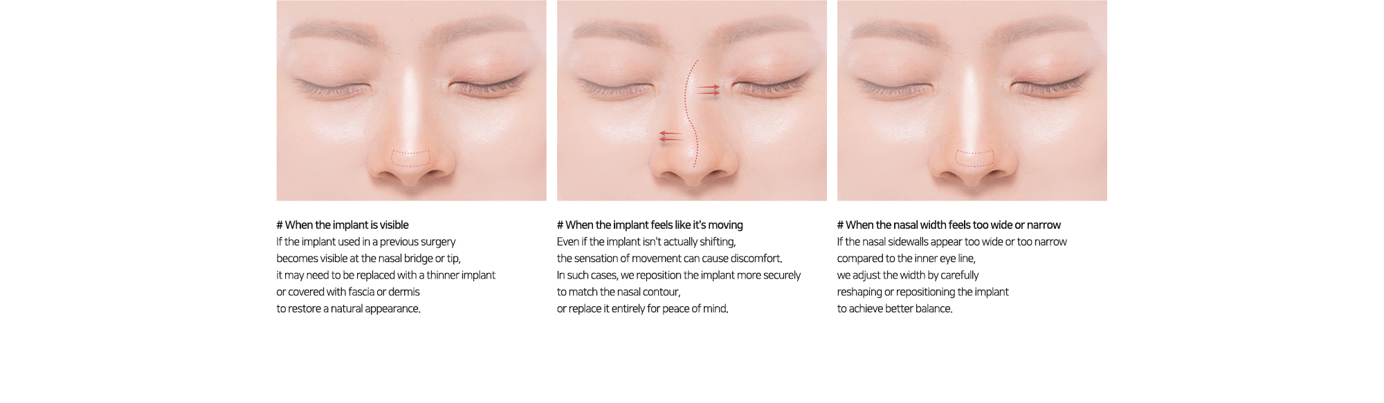 # When the implant is visible   # When the implant feels like it's moving   # When the nasal width feels too wide or narrow