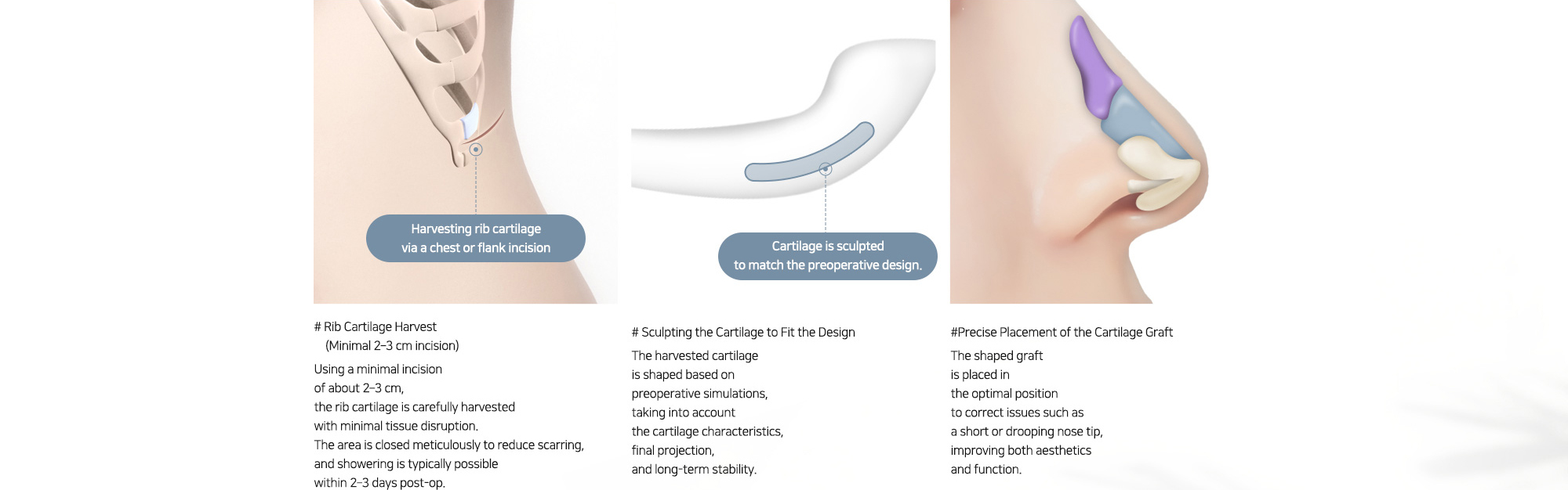# Rib Cartilage Harvest (Minimal 2–3 cm incision) : Using a minimal incision of about 2–3 cm, the rib cartilage is carefully harvested with minimal tissue disruption. The area is closed meticulously to reduce scarring, and showering is typically possible within 2–3 days post-op.   # Sculpting the Cartilage to Fit the Design : The harvested cartilage is shaped based on preoperative simulations, taking into account the cartilage characteristics, final projection, and long-term stability.   #Precise Placement of the Cartilage Graft : The shaped graft is placed in the optimal position to correct issues such as a short or drooping nose tip, improving both aesthetics and function.