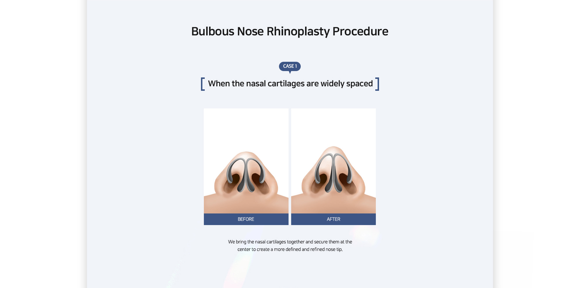 [Bulbous Nose Rhinoplasty Procedure] {CASE 1} When the nasal cartilages are widely spaced : We bring the nasal cartilages together and secure them at the center to create a more defined and refined nose tip.