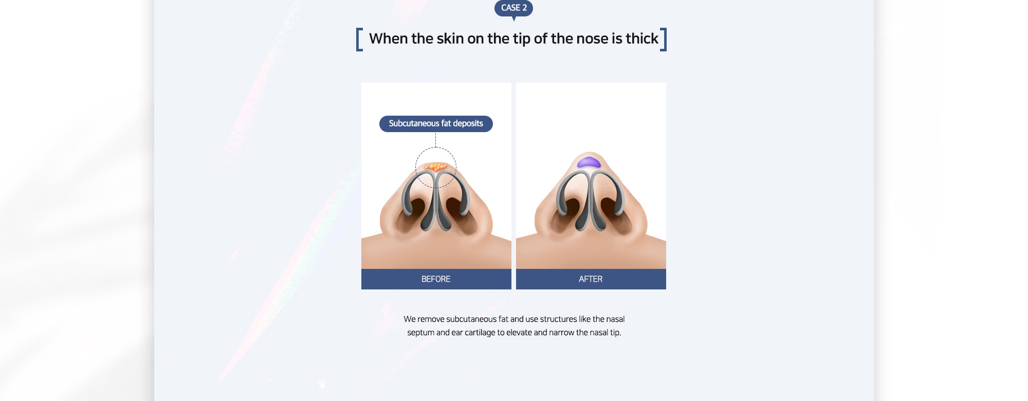 {CASE 2} When the skin on the tip of the nose is thick : We remove subcutaneous fat and use structures like the nasal septum and ear cartilage to elevate and narrow the nasal tip.
