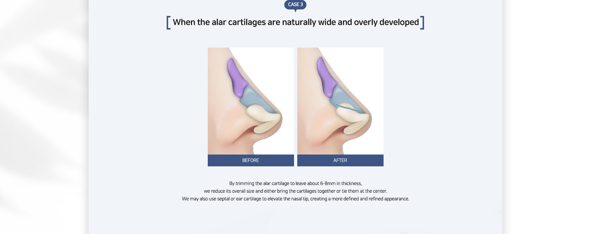 {CASE 3} When the alar cartilages are naturally wide and overly developed : By trimming the alar cartilage to leave about 6–8mm in thickness, we reduce its overall size and either bring the cartilages together or tie them at the center. We may also use septal or ear cartilage to elevate the nasal tip, creating a more defined and refined appearance.