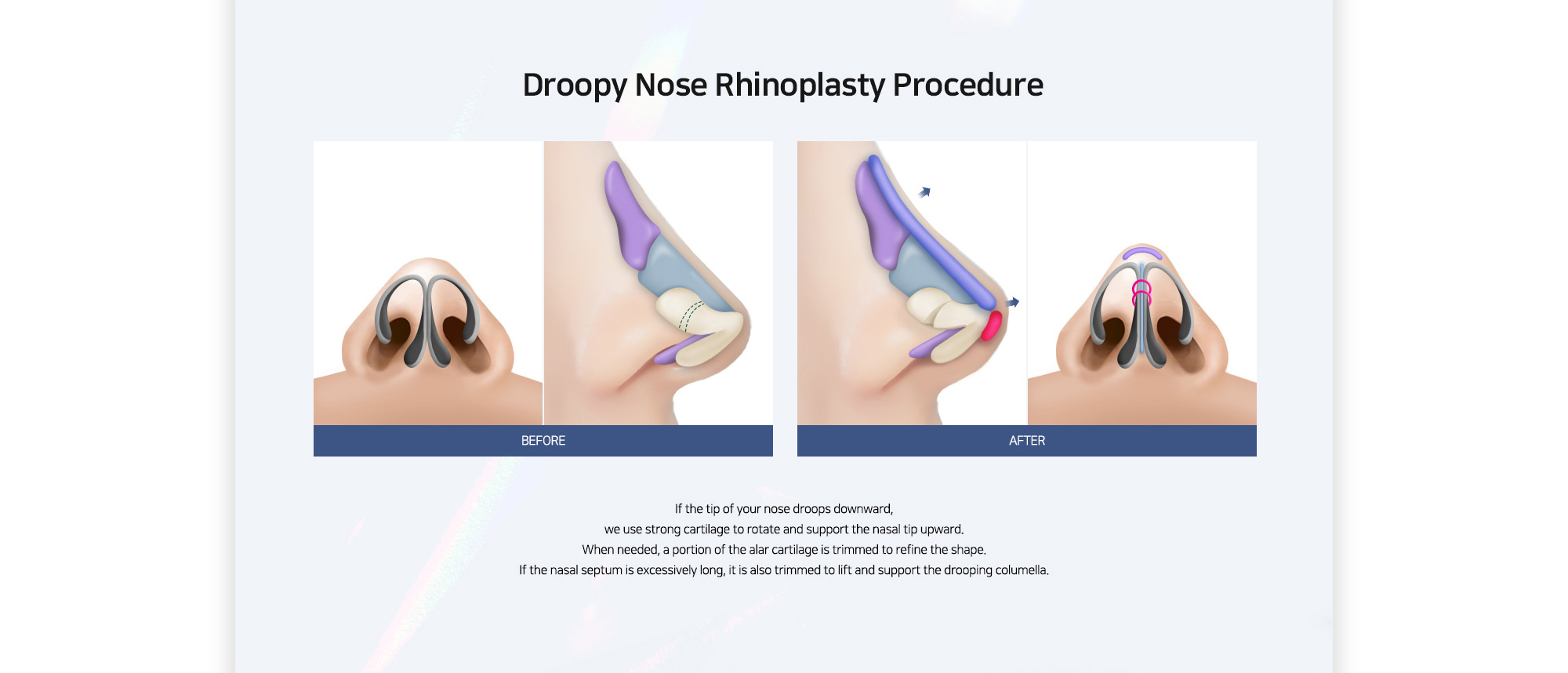 [Droopy Nose Rhinoplasty Procedure] If the tip of your nose droops downward, we use strong cartilage to rotate and support the nasal tip upward. When needed, a portion of the alar cartilage is trimmed to refine the shape. If the nasal septum is excessively long, it is also trimmed to lift and support the drooping columella.