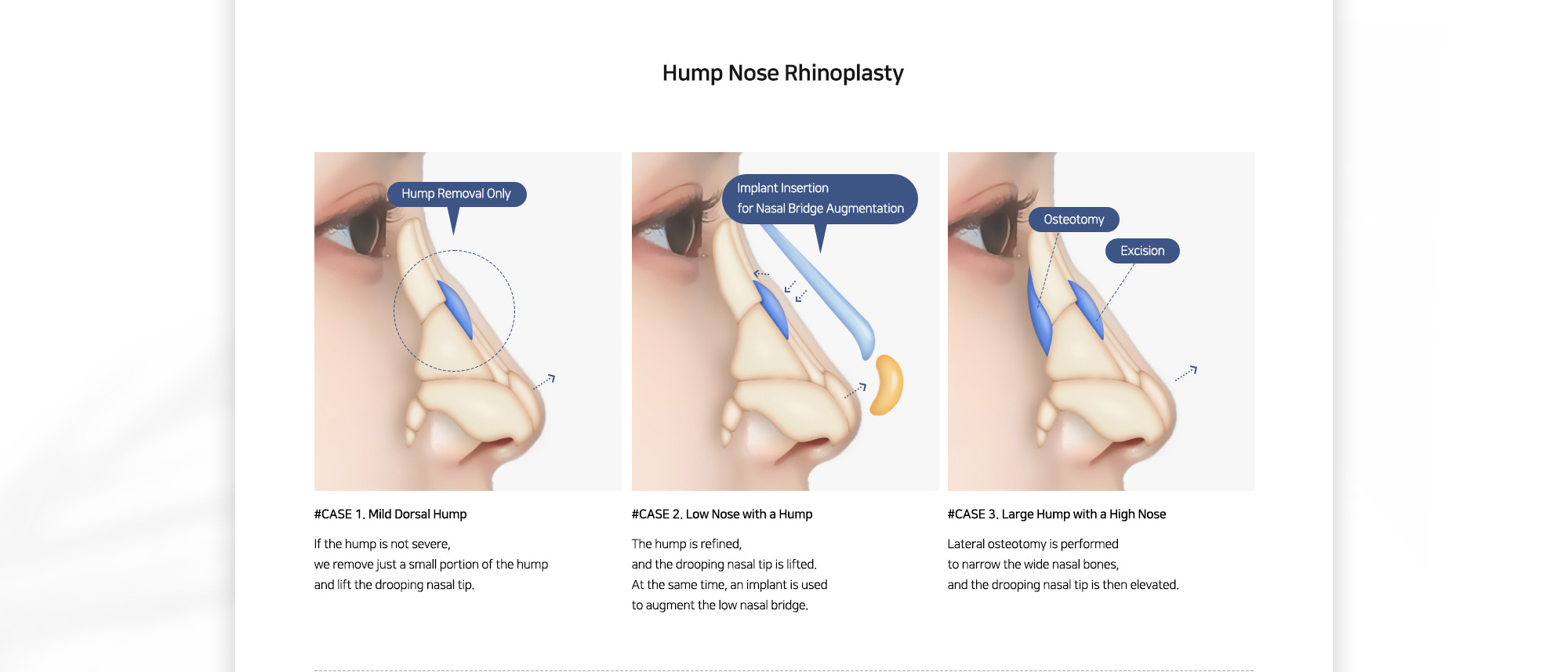 [Hump Nose Rhinoplasty] #CASE 1. Mild Dorsal Hump : If the hump is not severe, we remove just a small portion of the hump and lift the drooping nasal tip. / #CASE 2. Low Nose with a Hump : The hump is refined, and the drooping nasal tip is lifted. At the same time, an implant is used to augment the low nasal bridge. / #CASE 3. Large Hump with a High Nose : Lateral osteotomy is performed to narrow the wide nasal bones, and the drooping nasal tip is then elevated.