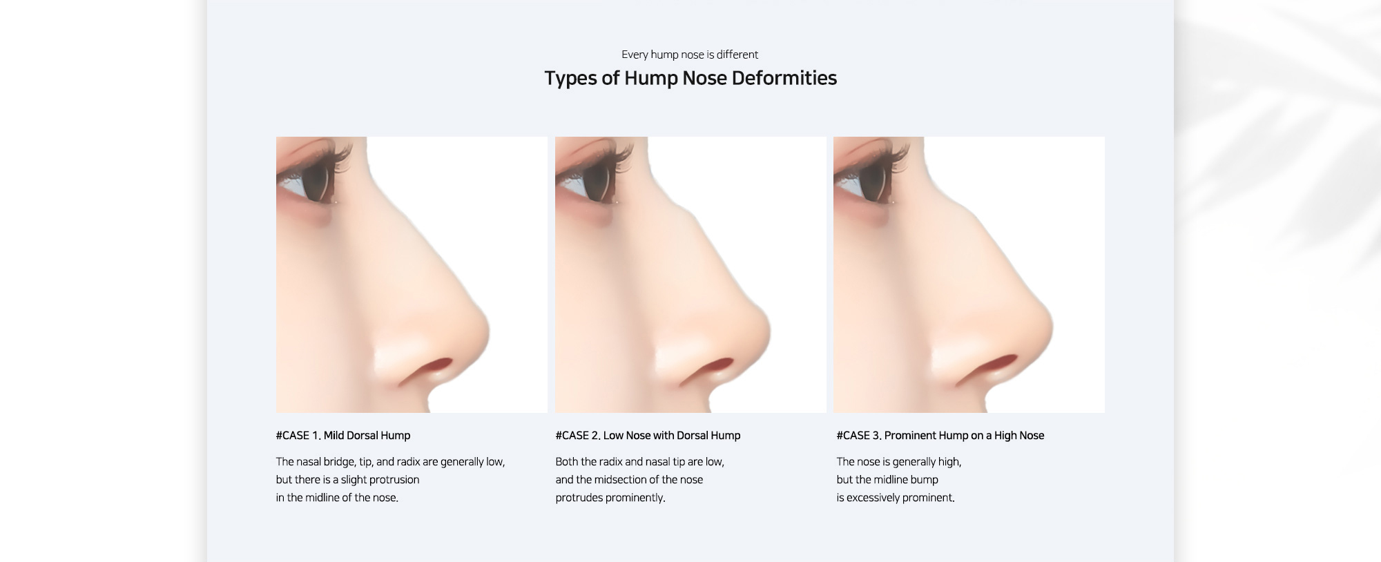 [Types of Hump Nose Deformities] #CASE 1. Mild Dorsal Hump / #CASE 2. Low Nose with Dorsal Hump / #CASE 3. Prominent Hump on a High Nose