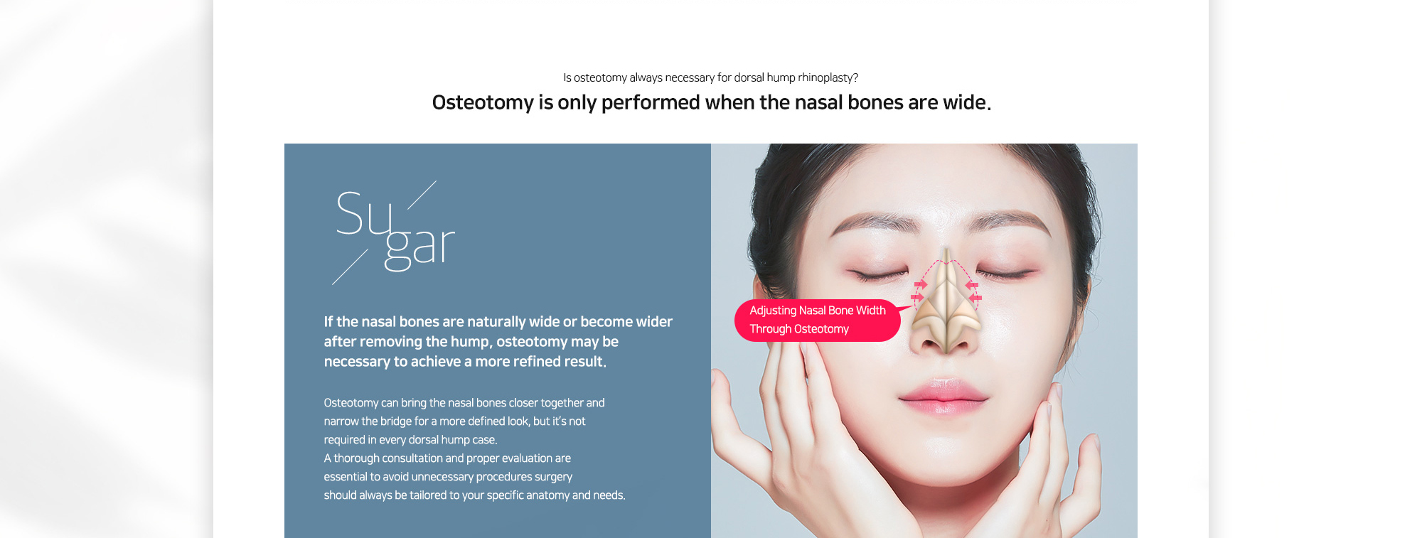 Is osteotomy always necessary for dorsal hump rhinoplasty? Osteotomy is only performed when the nasal bones are wide. If the nasal bones are naturally wide or become wider after removing the hump, osteotomy may be necessary to achieve a more refined result.