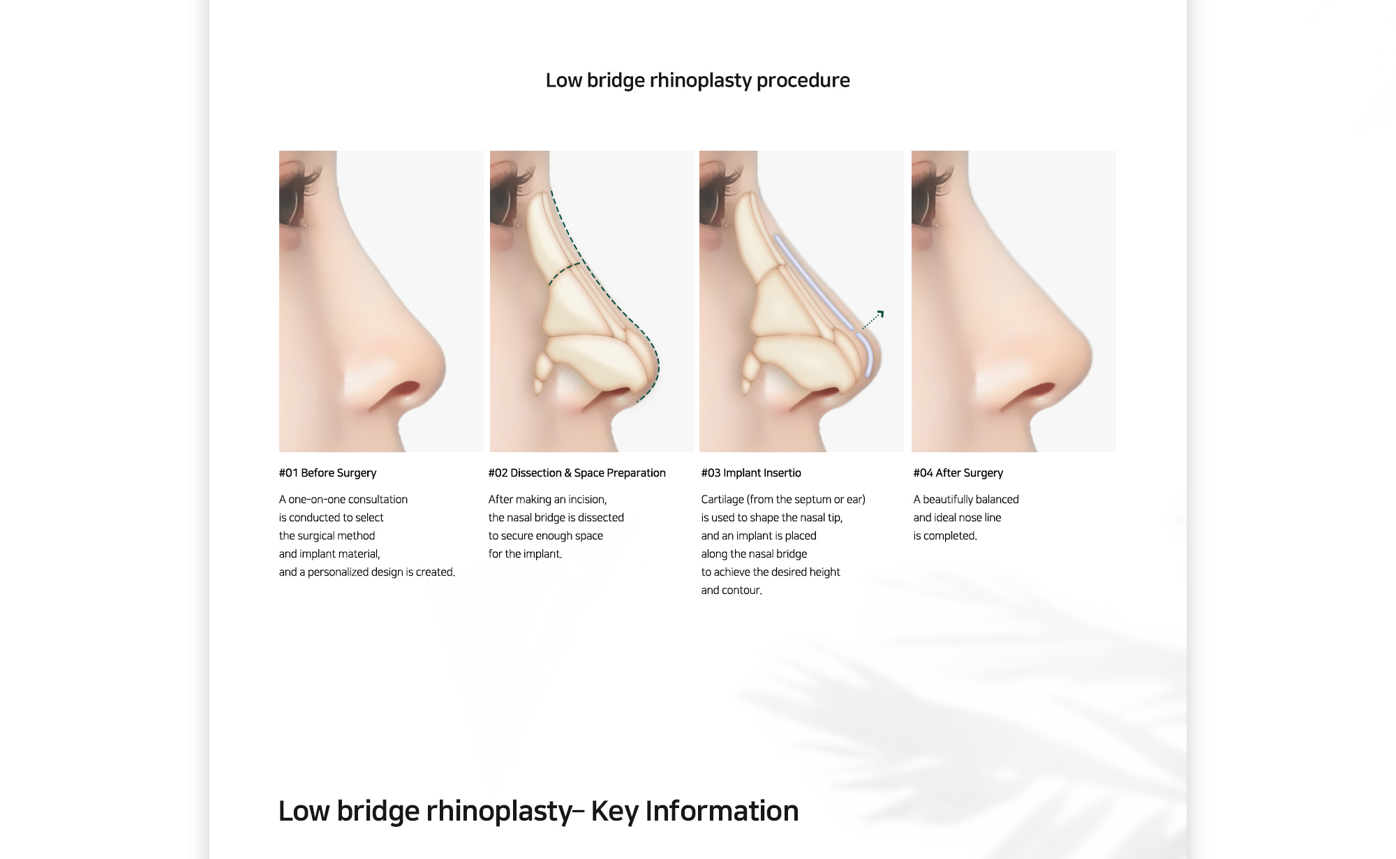 [Low bridge rhinoplasty procedure] #01 : A one-on-one consultation is conducted to select the surgical method and implant material, and a personalized design is created. #02 : After making an incision, the nasal bridge is dissected to secure enough space for the implant. #03 : Cartilage (from the septum or ear) is used to shape the nasal tip, and an implant is placed along the nasal bridge to achieve the desired height and contour. #04 : A beautifully balanced and ideal nose line is completed.