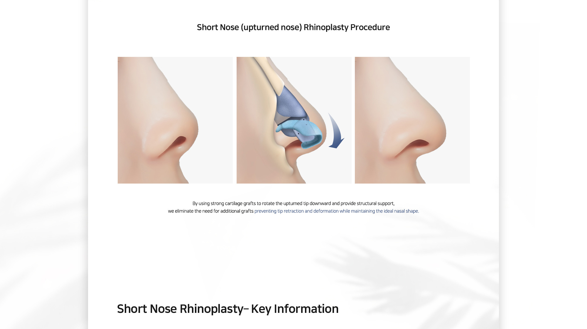 [Short Nose (upturned nose) Rhinoplasty Procedure] By using strong cartilage grafts to rotate the upturned tip downward and provide structural support, we eliminate the need for additional grafts preventing tip retraction and deformation while maintaining the ideal nasal shape.