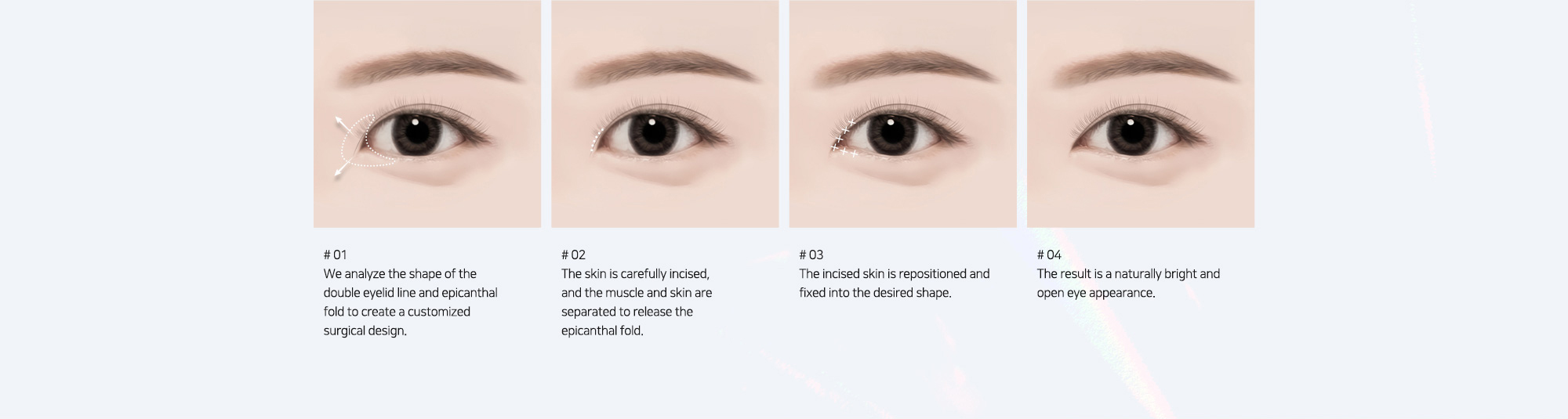 # 01 : We analyze the shape of the double eyelid line and epicanthal fold to create a customized surgical design.   # 02 : The skin is carefully incised, and the muscle and skin are separated to release the epicanthal fold.   # 03 : The incised skin is repositioned and fixed into the desired shape.   # 04 : The result is a naturally bright and open eye appearance.
