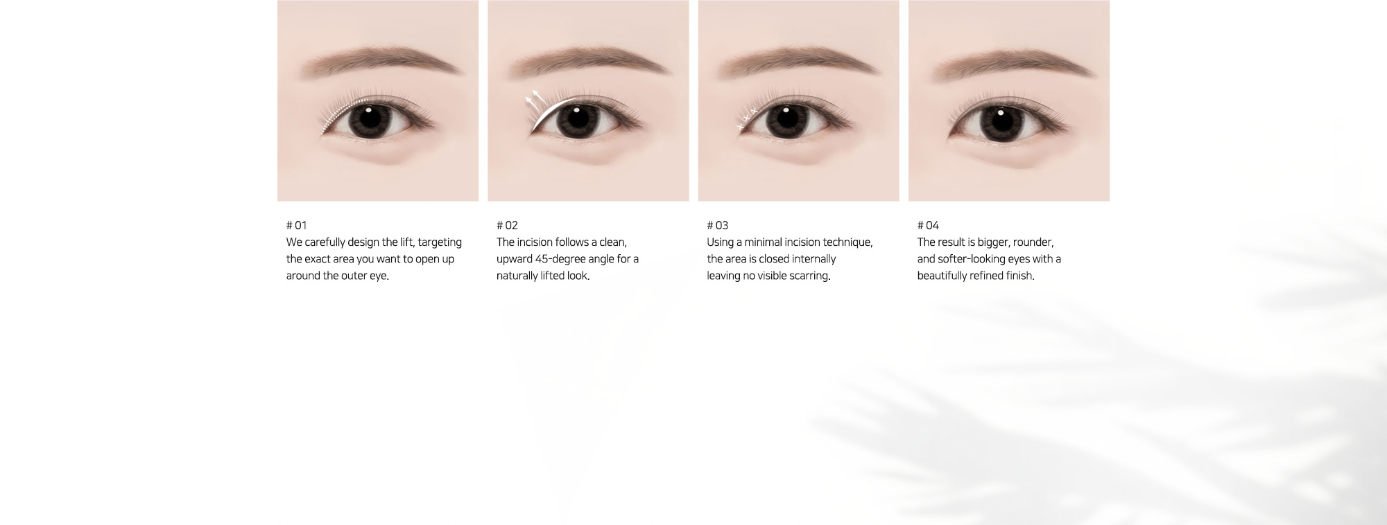# 01 : We carefully design the lift, targeting the exact area you want to open up around the outer eye.   # 02 : The incision follows a clean, upward 45-degree angle for a naturally lifted look.   # 03 : Using a minimal incision technique, the area is closed internally leaving no visible scarring.   # 04 : The result is bigger, rounder, and softer-looking eyes with a beautifully refined finish.