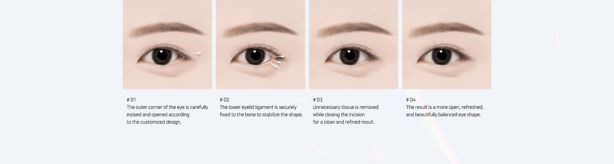 # 01 : The outer corner of the eye is carefully incised and opened according to the customized design.   # 02 : The lower eyelid ligament is securely fixed to the bone to stabilize the shape.   # 03 : Unnecessary tissue is removed while closing the incision for a clean and refined result.   # 04 : The result is a more open, refreshed, and beautifully balanced eye shape.