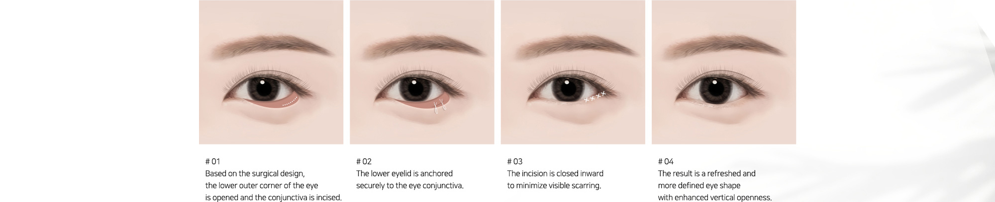 # 01 : Based on the surgical design, the lower outer corner of the eye is opened and the conjunctiva is incised.   # 02 : The lower eyelid is anchored securely to the eye conjunctiva.   # 03 : The incision is closed inward to minimize visible scarring.   # 04 : The result is a refreshed and more defined eye shape with enhanced vertical openness.
