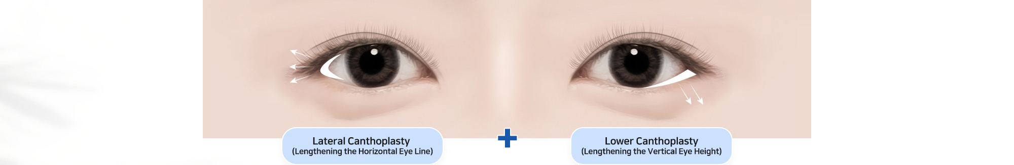 Brighten and Refine Your Eyes with Lateral + Lower Canthoplasty! Perfect for those with short eye length or sharp outer corners this combo creates a more refreshed and elegant look.